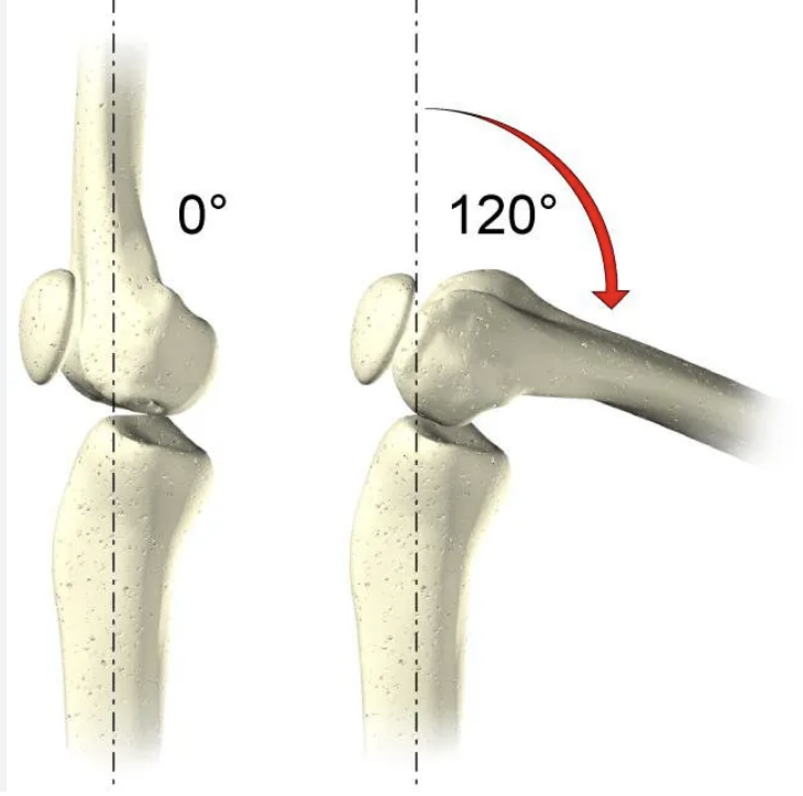 <p>Superfici articolari:</p><ul><li><p>Superiormente i Condili del Femore, arrotondati e convessi</p></li><li><p>Inferiormente dei Condili Tibiali, piani</p></li><li><p>Anteriormente la Patella (che si articola con la superficie patellare del femore)</p></li><li><p>Quindi abbiamo l’articolazione femoro-tibiale e femoro-patellare</p></li></ul><p>E’ un articolazione sinoviale di tipo GINGLIMO ANGOLARE:</p><ul><li><p>Però oltre Flessione ed Estensione permette anche Scivolamento e Rotazione (nell’insieme Rotolamento):</p><ul><li><p> (durante la rotazione il condilo femorale si sposta avanti o indietro rispetto al piatto tibiale), movimento che comunque avviene durante flesso/estensione.</p></li></ul></li><li><p>Parliamo allora di Ginglimo Modificato dovuta alla geometria piatta su convessa</p></li></ul><p></p>