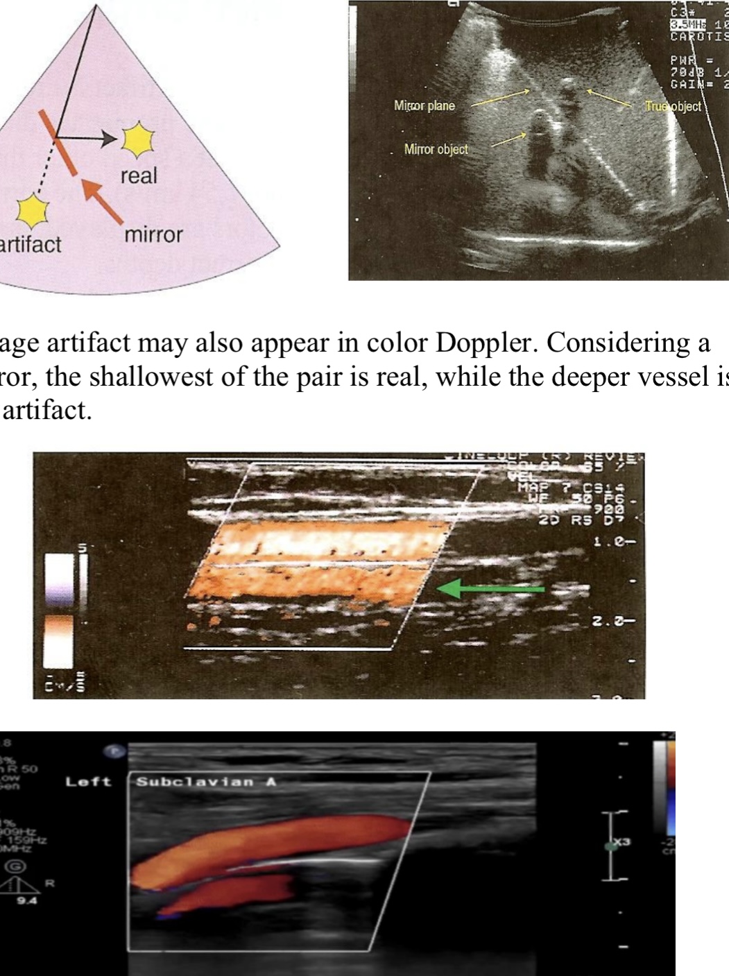 <p>When sound reflects off a strong reflector, which acts like a mirror, a mirror image artifact is created → the sound is redirected towards a second structure, this redirection causes a replica or second copy, which is the mirror image</p><ul><li><p>artifact is placed deeper than the real anatomic structure, &amp; always located along a straight line between the transducer &amp; the artifact</p></li><li><p>Artifact may appear in Color doppler</p></li></ul>