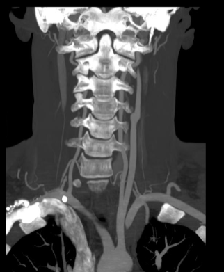 <p>Wat is kenmerkend op CT scans?</p>