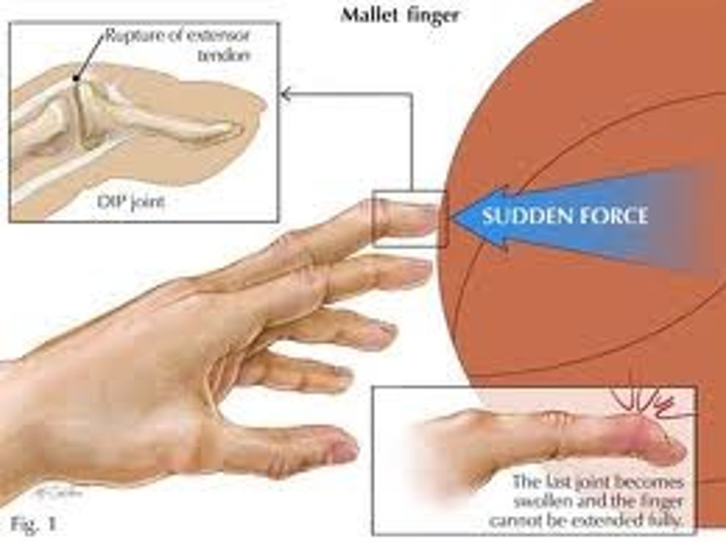 <p>- rupture and avulsion of the extensor tendon at distal phalanx</p><p>- tendon can't retract</p><p>- immobilize in hyperextension for 8 weeks</p><p>- DIP can't extend</p>