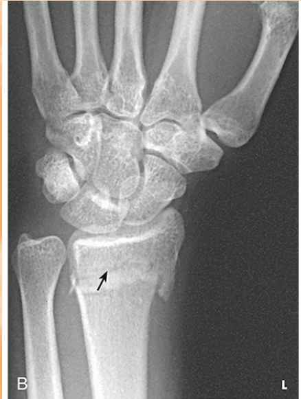 <p>fx of distal radius with anterior displacement (inward) </p>