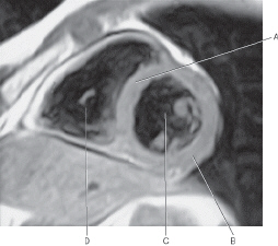 <p>In the figure below of a short-axis, T1-weighted MRI of the heart, which line points to the<mark data-color="purple"> left ventricle</mark>?</p>