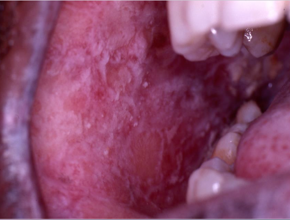 <p>What conditions can mimic oral lichen planus?</p>
