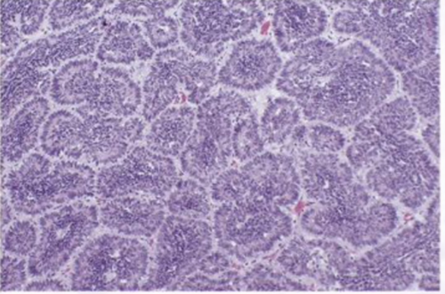<p>Benign Salivary Gland Tumors:</p><p>Uncommon, Primarily tumor of Parotid</p>
