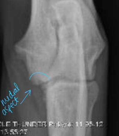 <p><span style="background-color: transparent;"><strong><span>Osteochondrosis + Osteochondritis Dissecans</span></strong></span></p>