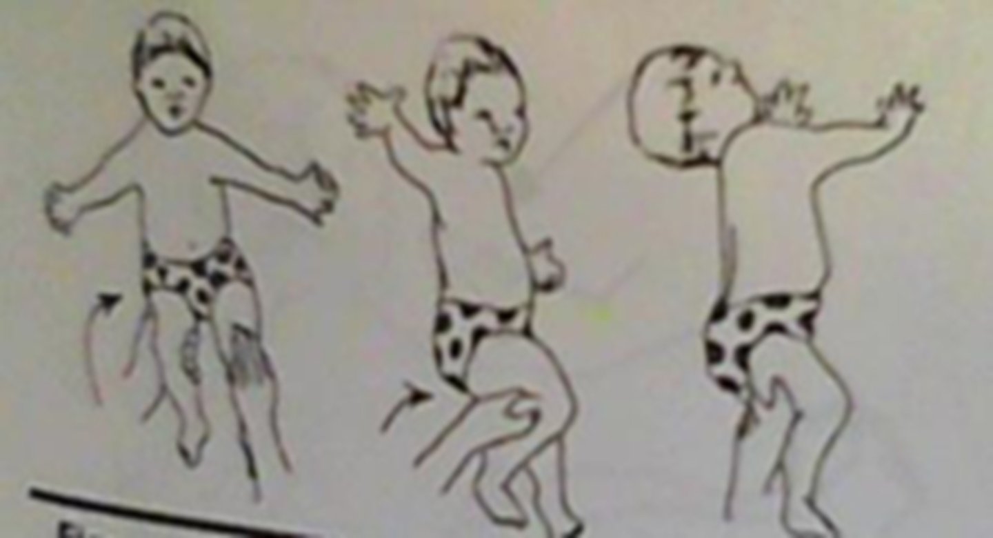 <p>passively rotate trunk/body into sidelying; head follows trunk and rotates to the same side</p>