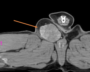 <p>subclassified by tissue of origin or phenotype:</p><p>-fibrosarcoma</p><p>-perivascular wall tumor</p><p>-peripheral nerve sheath tumor</p><p>-liposarcoma</p><p>-etc.</p>