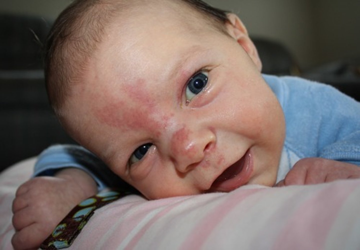 <p>Flat, deep pink, localized areas usually seen in the back of the neck.</p><p>- AKA stork bites or salmon patch.</p><p>- They are birth marks; disappears by age 2</p>