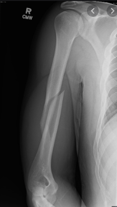 <p>What kind of fracture is this?</p>