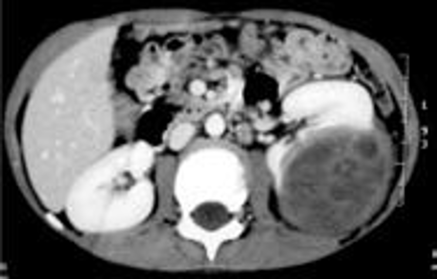 <p>Diagnosis: abdominal CT, F/U w/ explorative laparotomy for biopsy if CT suggestive of a mass</p><p>Treatment: surgery &amp; chemo (radiation for later stages)</p>