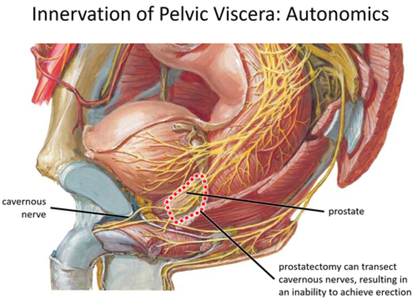 <p>surgical removal of the prostate</p>