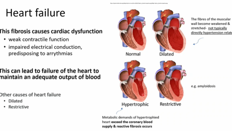 Systemic hypertension and heart failure Flashcards | Knowt