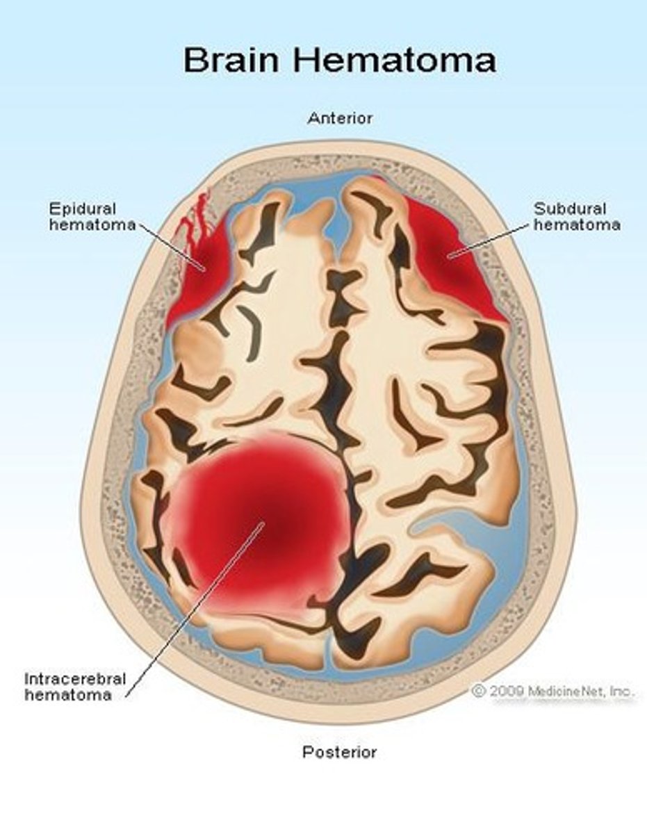 <p>A collection of blood outside of blood vessels, which can occur outside or within the brain tissue.</p>