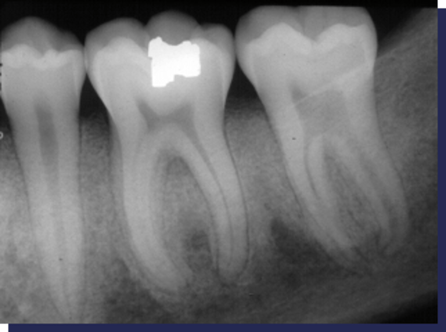 <p>These sclerotic changes around the roots is associated with :</p>
