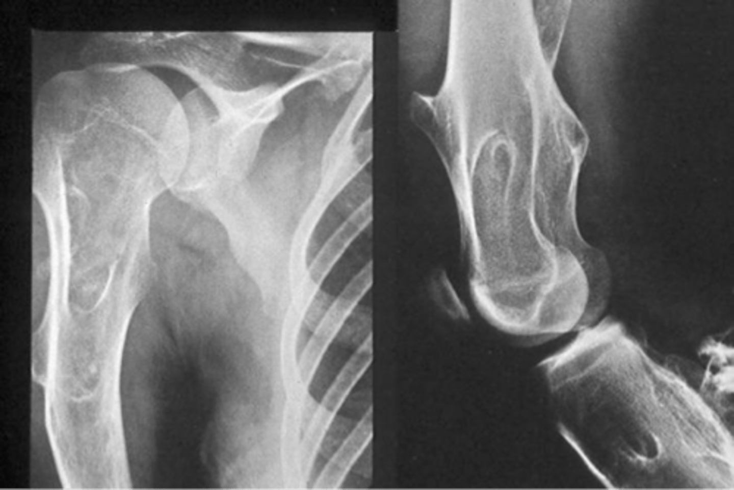 <p>Hereditary multiple exostoses malignant transformation rate</p>
