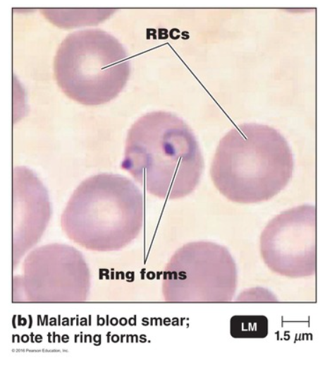 <p><strong>D</strong></p><p></p><p>A recurrent fever is common in cases of malaria. While this is not the only disease that can cause a recurrent fever, it is an important symptom for diagnosis of this disease.</p><p>—</p><p><strong>A</strong></p><p></p><p>A blood smear is commonly used for diagnosis of malaria. In cases of malaria, ring forms will be visible in red blood cells.</p><p>—</p><p><strong>E</strong></p><p></p><p><em>Plasmodium</em> species are carried by mosquitoes in the genus <em>Anopheles. </em>Mosquito control programs have helped to reduce cases of malaria in the USA.</p>
