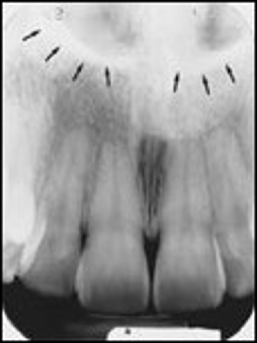 <p>What is the radiolucent structure seen here?</p>