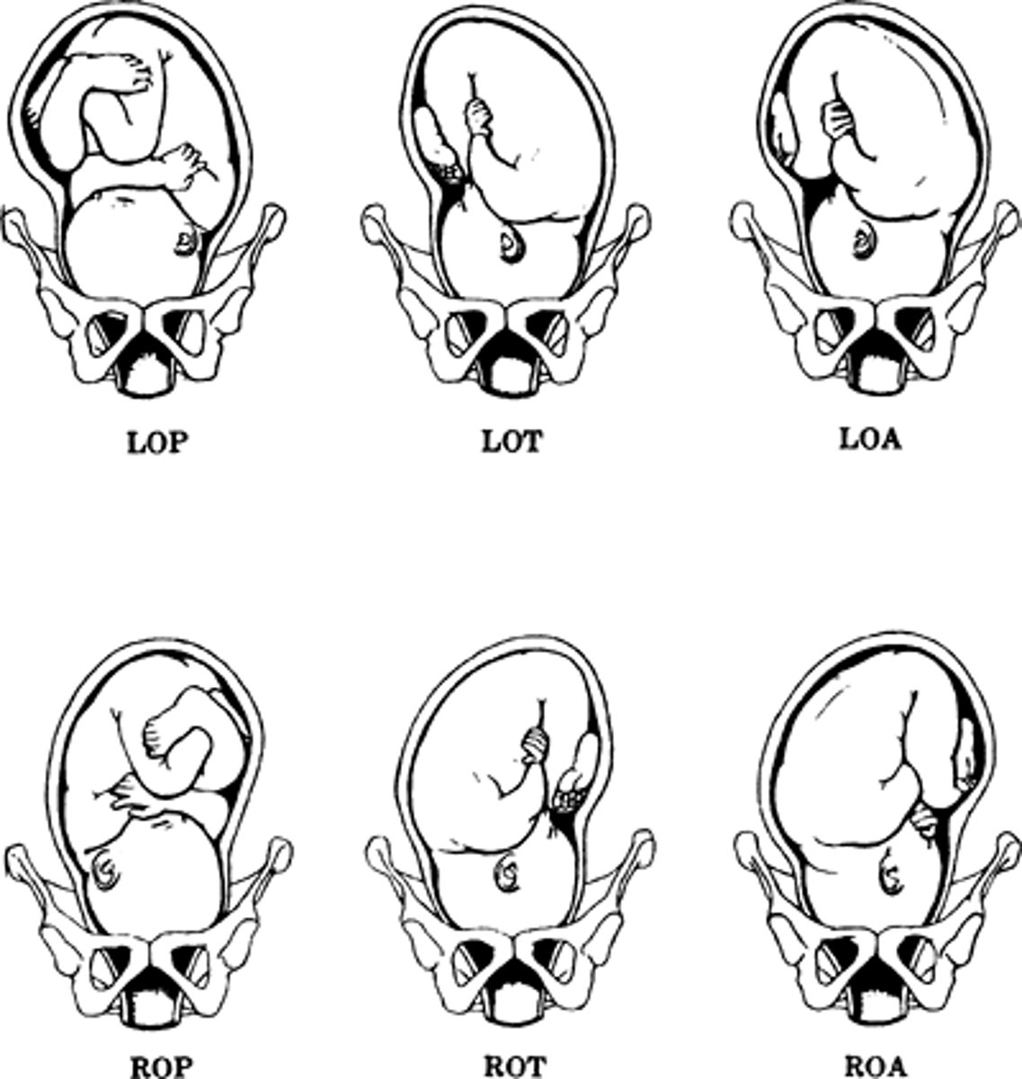 <p>Described w/ a series of 3 letters</p><p>1st letter = Right (R) or Left (L) - Refers to MATERNAL R or L</p><p>2nd letter = Presenting part (fetal)</p><p>Occipital bone (O): vertex presentation</p><p>Chin (mentum [M]): brow/face presentation</p><p>Buttocks (sacrum [S]): breech presentation</p><p>Scapula (acromion process [A]): shoulder presentation</p><p>3rd letter = position of the presenting part as</p><p>Posterior (P)</p><p>Anterior (A)</p><p>Transverse (T)</p><p>Examples:</p><p>Left Occiput Anterior (LOA)</p><p>Occiput Posterior (OP)</p>