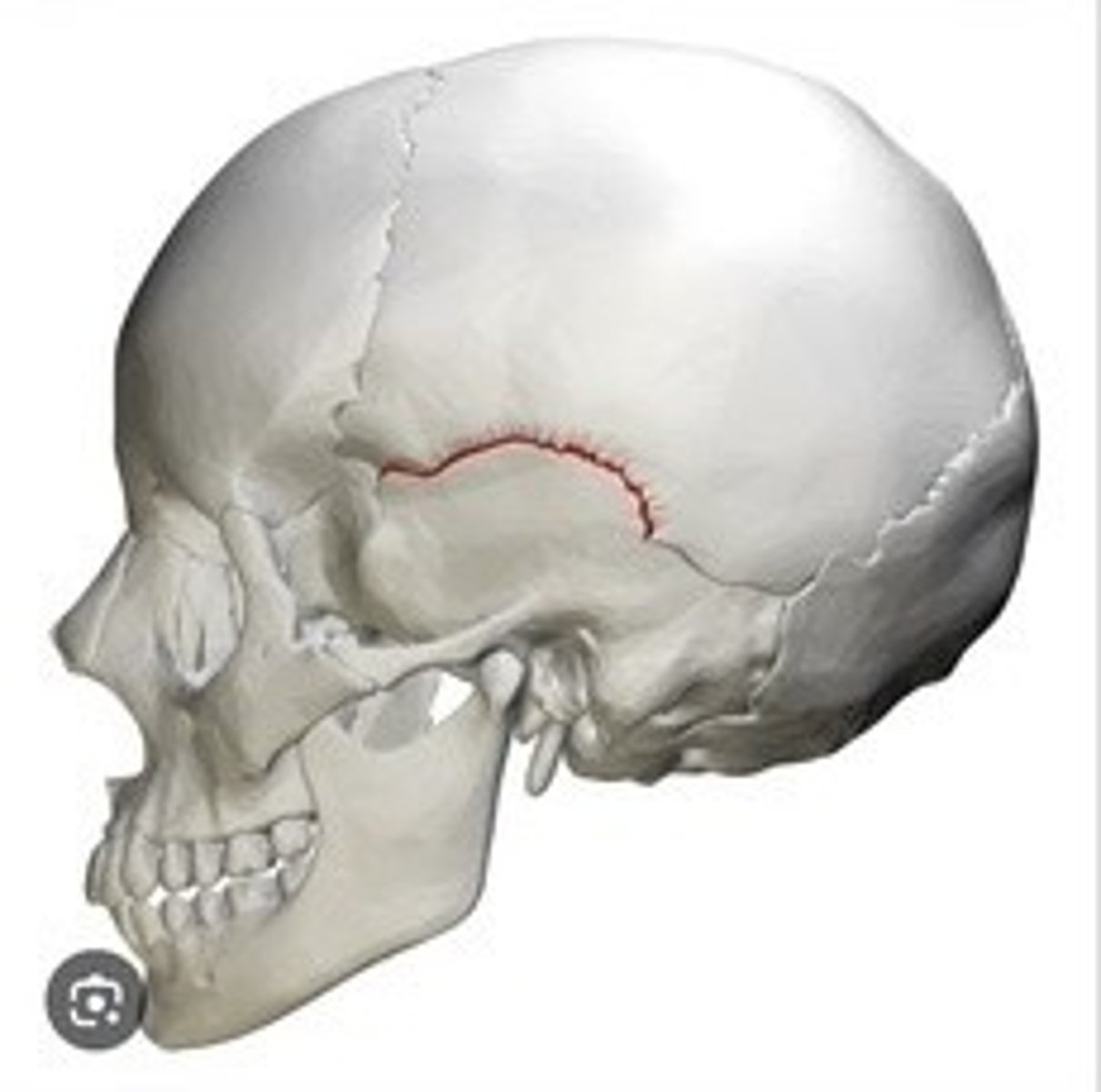 <p>Suture between parietal and temporal bones.</p>