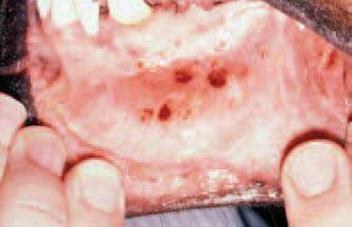 <p>Enfermedad autoinmune vesiculobullosa en perros y gatos, se generan anticuerpos contra glucoproteínas de transmembrana específica de los queratinocitos basales</p><p>Generalmente en pinea, axilas y gingiva</p>