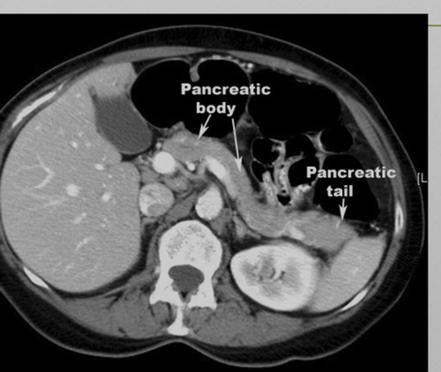<p>xray- may show calcified gallstones, localized ileus</p><p>US- not helpful in acute pancreatitis, may identify gallstones</p><p>CT- differentiating pancreatitis from other possibilities, enlarged pancreas</p>