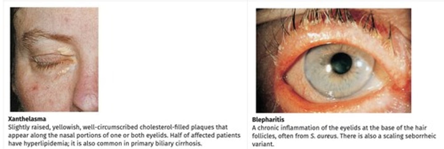 <p>Ptosis, entropion, ectropion, exophthalmos, blepharitis, hordeolum, chalazion, xanthelasma.</p>