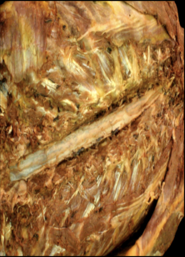 <p>Laminectomy Completed</p>