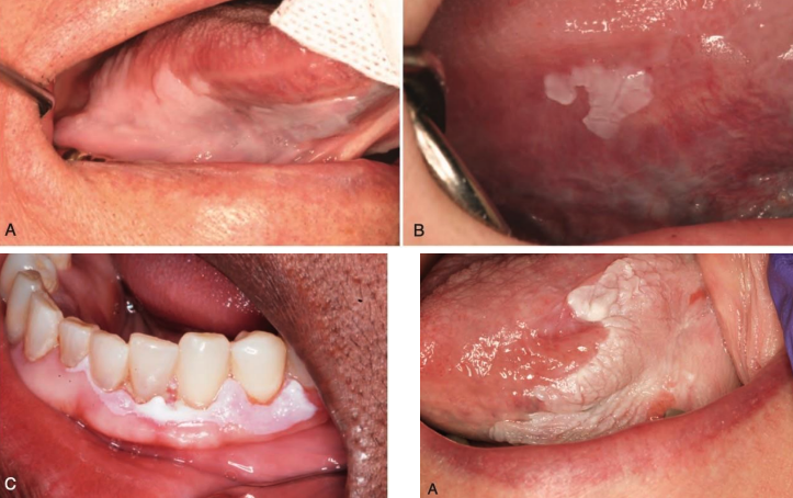 <ul><li><p>homogenous (16%)</p></li><li><p>non-homogenous</p></li><li><p>proliferative leukoplakia (70-100%)</p></li></ul><p></p>