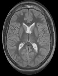 <p><strong>Which of the following individuals would most likely experience global ischemia to his</strong></p><p><strong>or her brain?</strong></p><p>A) A male client who has just had an ischemic stroke confirmed by CT of his head</p><p>B) A woman who has been admitted to the emergency department with a suspected intracranial bleed</p><p>C) A man who has entered cardiogenic shock following a severe myocardial infarction</p><p>D) A woman who is being brought to hospital by ambulance following suspected carbon monoxide poisoning related to a faulty portable heater</p>