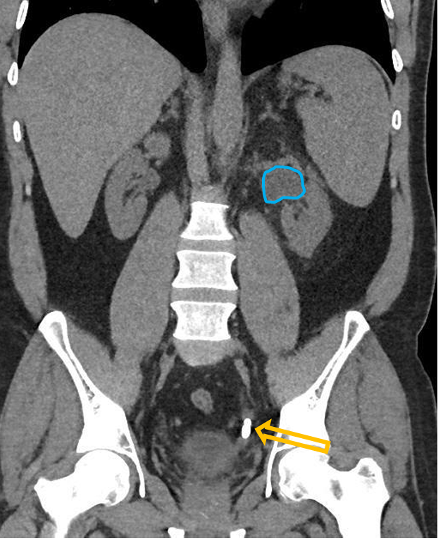 <p>Patient history: acute severe left-sided flank pain, hematuria in a young patient</p><p>Modality: low-dose non-enhanced CT scan </p><p>Region: abdomen, coronal view </p><p>Radiologic sign: juxtavesical hyperdensity (yellow arrow, 450-500 HU) in the left distal ureter with ipsilateral hydronephrosis (blue area – dilated pyelon) </p><p>Diagnosis: obliterative juxtavesical ureter stone with hydronephrosis</p>