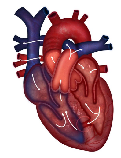 __**● Defect:**__  

○ Opening between the ventricles 

__**● Shunt:**__  

○ Left to right. Acyanotic  

__**● History:**__  

○ Typical for s/s of HF to begin at 2-8 weeks 

__**● Assessment findings:**__  

○ Loud murmur ○ CHF 

__**● Treatment**__  

○ CHF management: Diuretics, ACE inhibitors, β-blockers 

○ Nutrition 

○ Surgical closure  

■ Bacterial endocarditis prophylaxis 