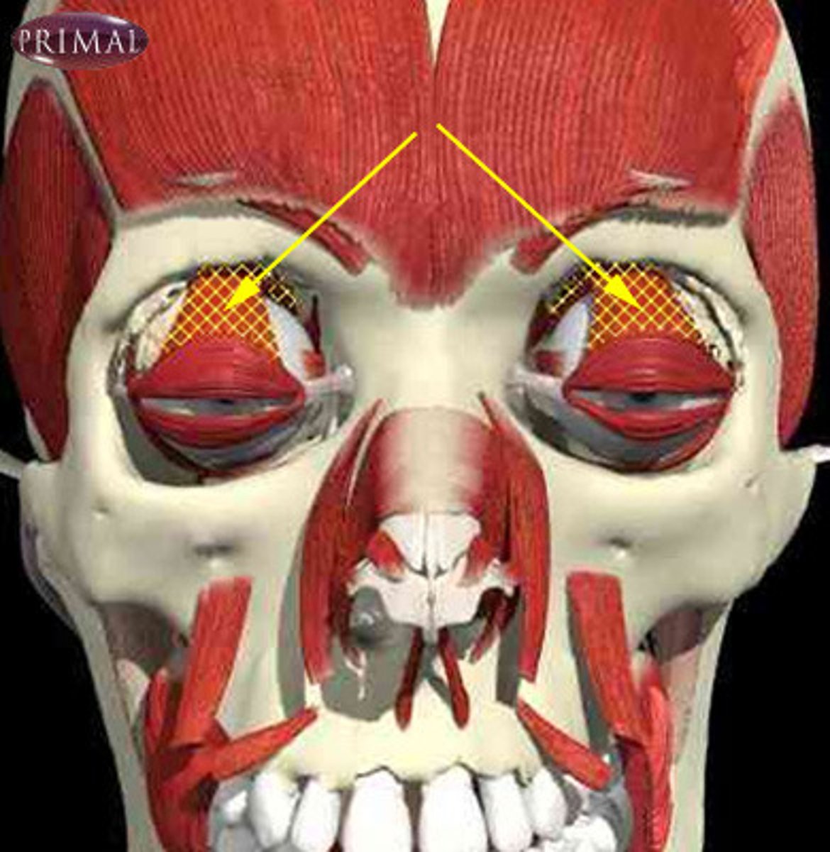 <p>Runs from medial eye socket to superior tarsal plate of eyelid; Raises/opens the upper eyelid; Droopy eyelid known as “ptosis” indicates oculomotor nerve damage to this muscle; Creates an additional challenge to the embalmer and/or restorative artist to attempt to correct or lessen this defect; This muscle is not found on your diagrams; Origin = At the lesser wing of the sphenoid; Insertion = At the skin of the eyelid</p>