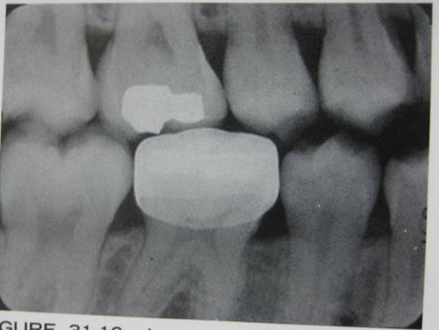 <p>on primary tooth</p><p>cheaper</p>