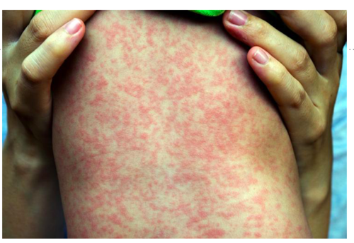 Measles