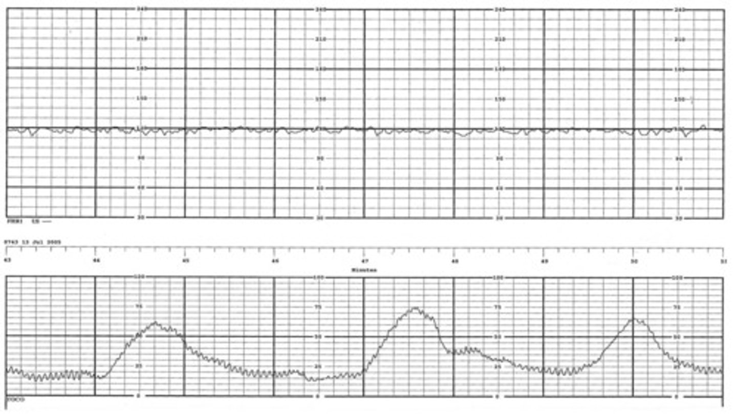 <p>-Greater than undetectable but less than 5 bpm per minute</p><p>-baby isn't moving that much</p><p>-baby may be asleep</p>