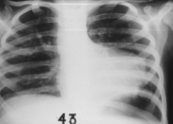 <p>X-Ray</p>