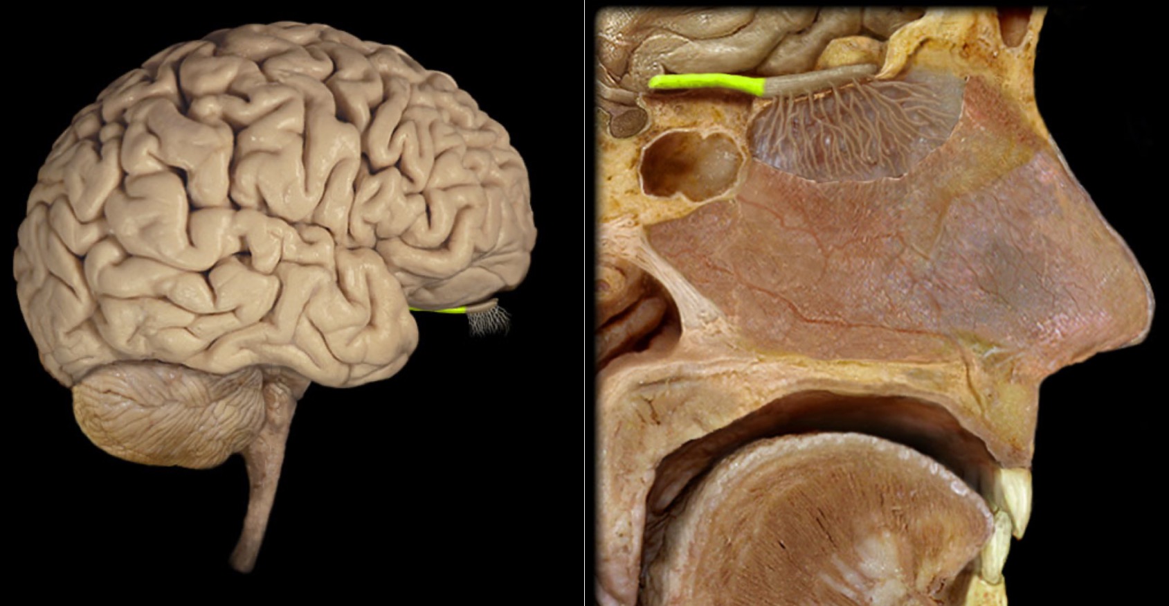 <h4 collapsed="false" seolevelmigrated="true"><strong>Location:</strong></h4><ul><li><p>Ventral aspect of frontal lobe</p></li><li><p>Between olfactory bulb and medial aspect of temporal lobe</p></li></ul><h4 collapsed="false" seolevelmigrated="true"><strong>Description:</strong></h4><ul><li><p>Bundles of afferent and efferent axons</p></li></ul>