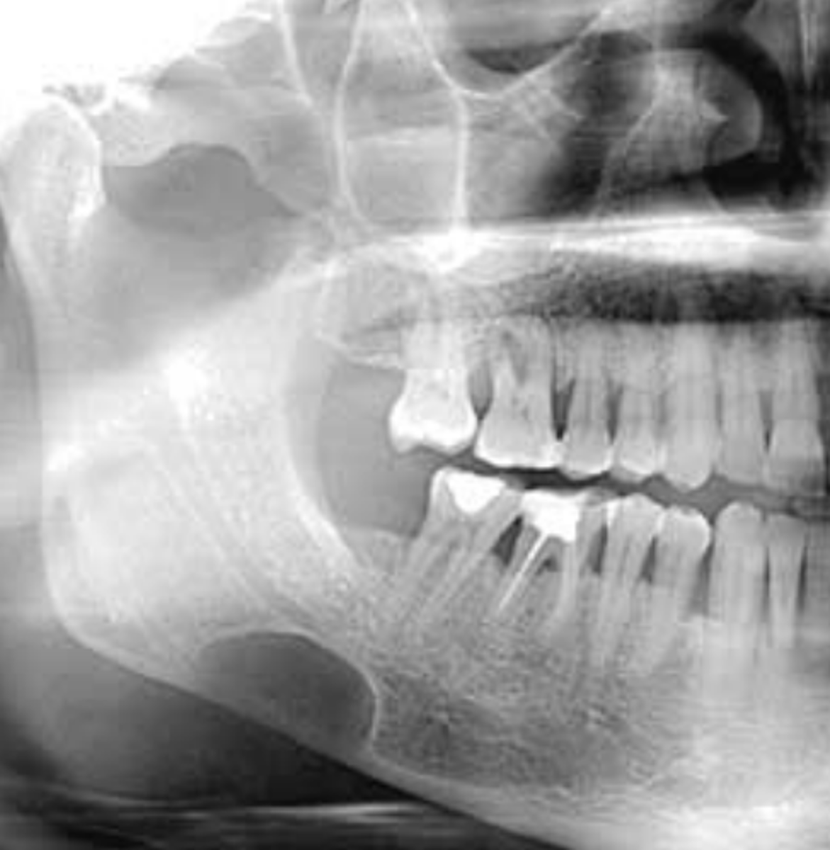 <p>1. anterior to angle of mand & inferior to mandibular canal</p><p>• unilateral or bilateral</p>