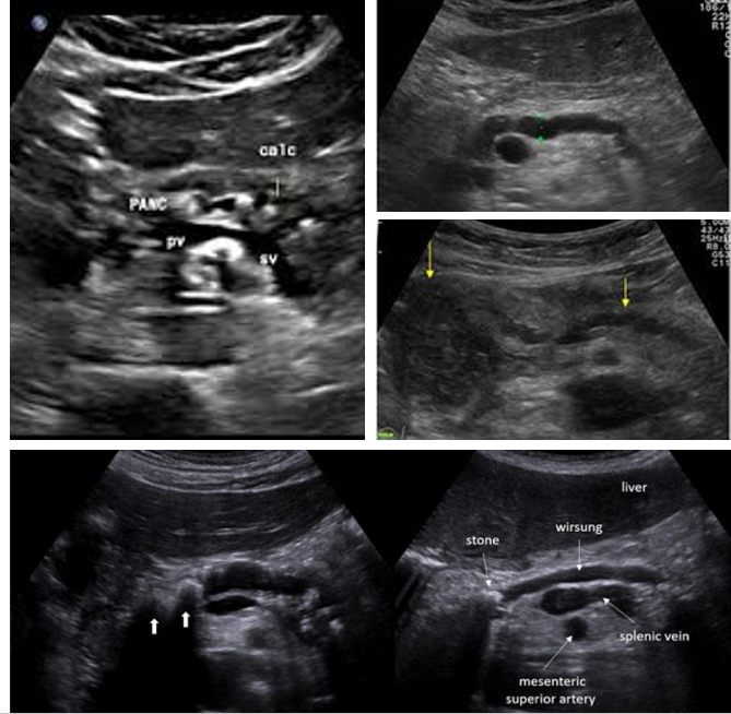 <p>Check pancreatic ducts for what?</p>