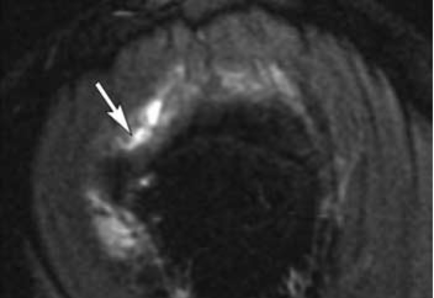<p>What is this image depicting w/ the rotator cuff? How do you know?</p>