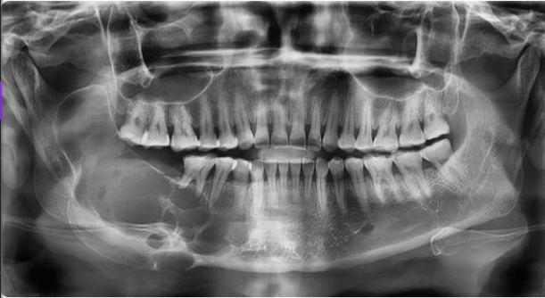 <p>neoplastic RL </p><p>multiocular “soap bubble” or “honeycomb”</p><ul><li><p>may look uni when small</p></li></ul><p>cortical expansion + thinning</p><p>aggressive but benign&nbsp;</p><p></p>