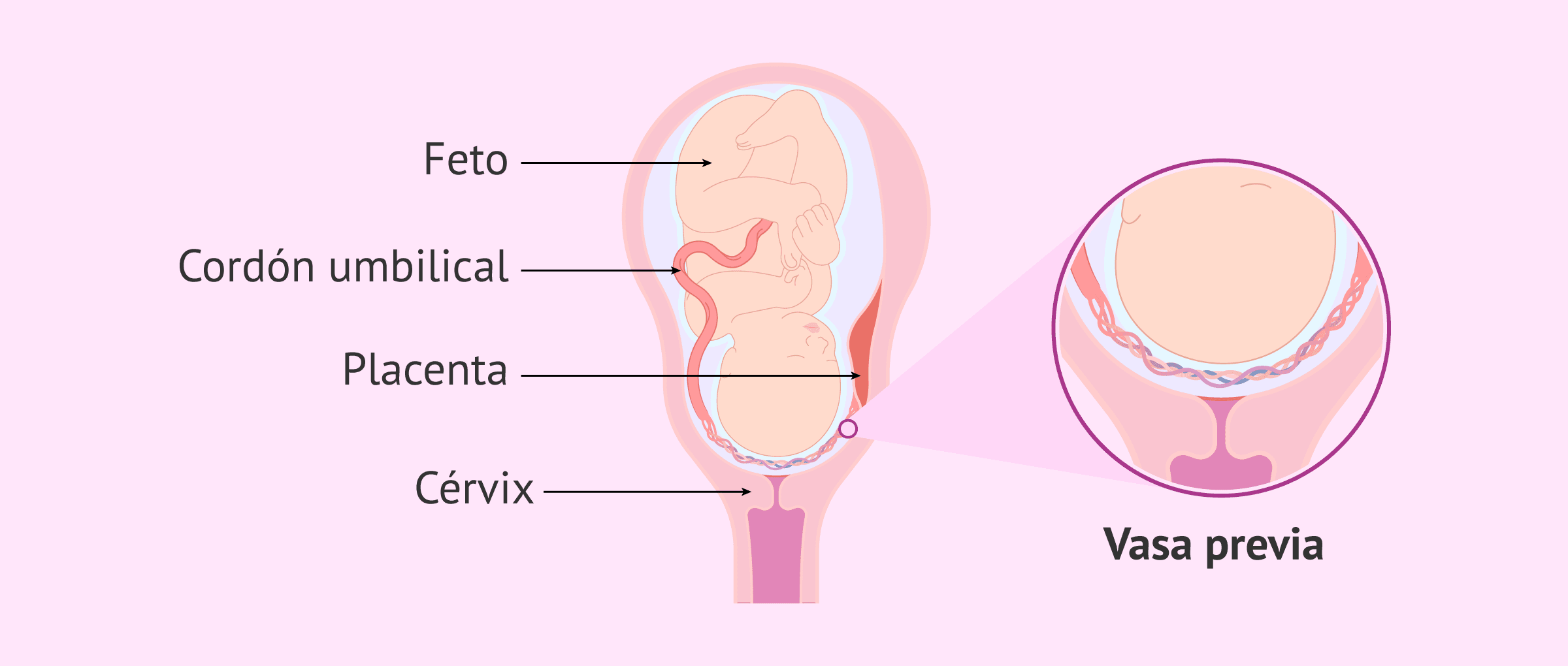 <p>Ruptura de vasa previa</p>