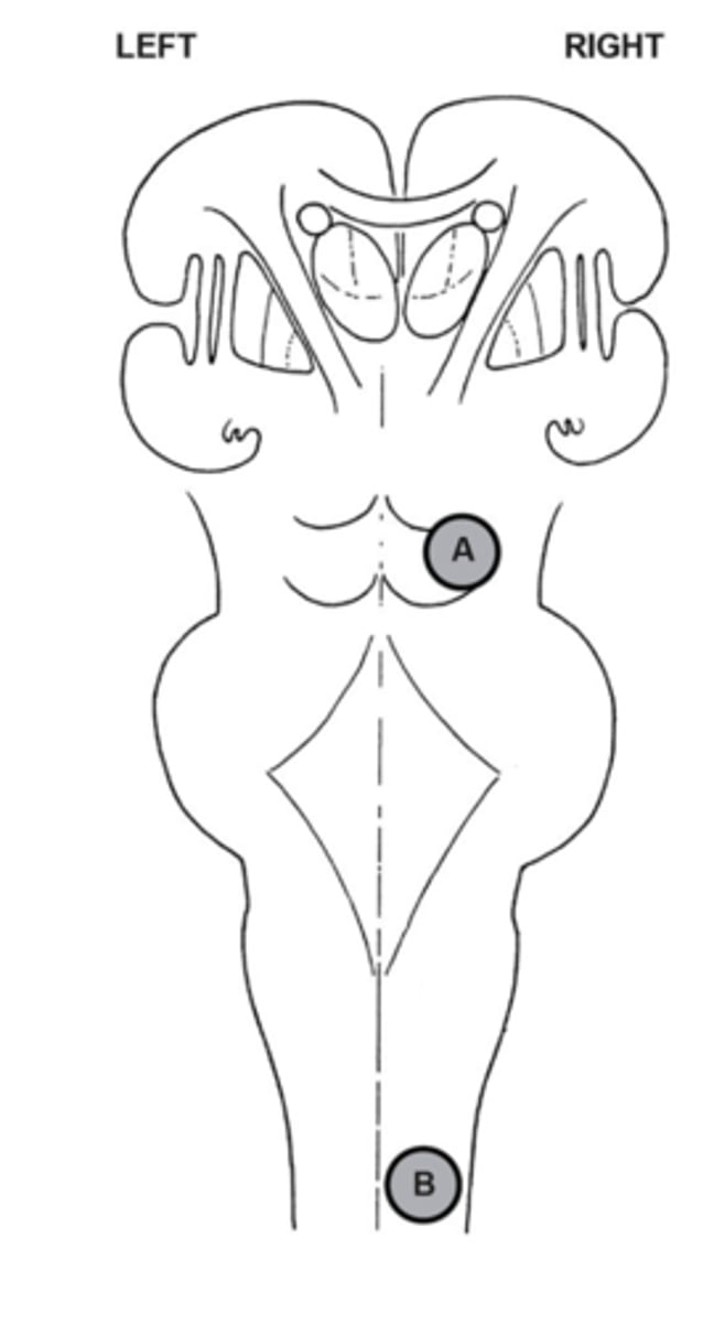 <p>Pain and Temperature: Left side</p><p>Touch and Pressure: Right side</p><p>Dissociative</p>