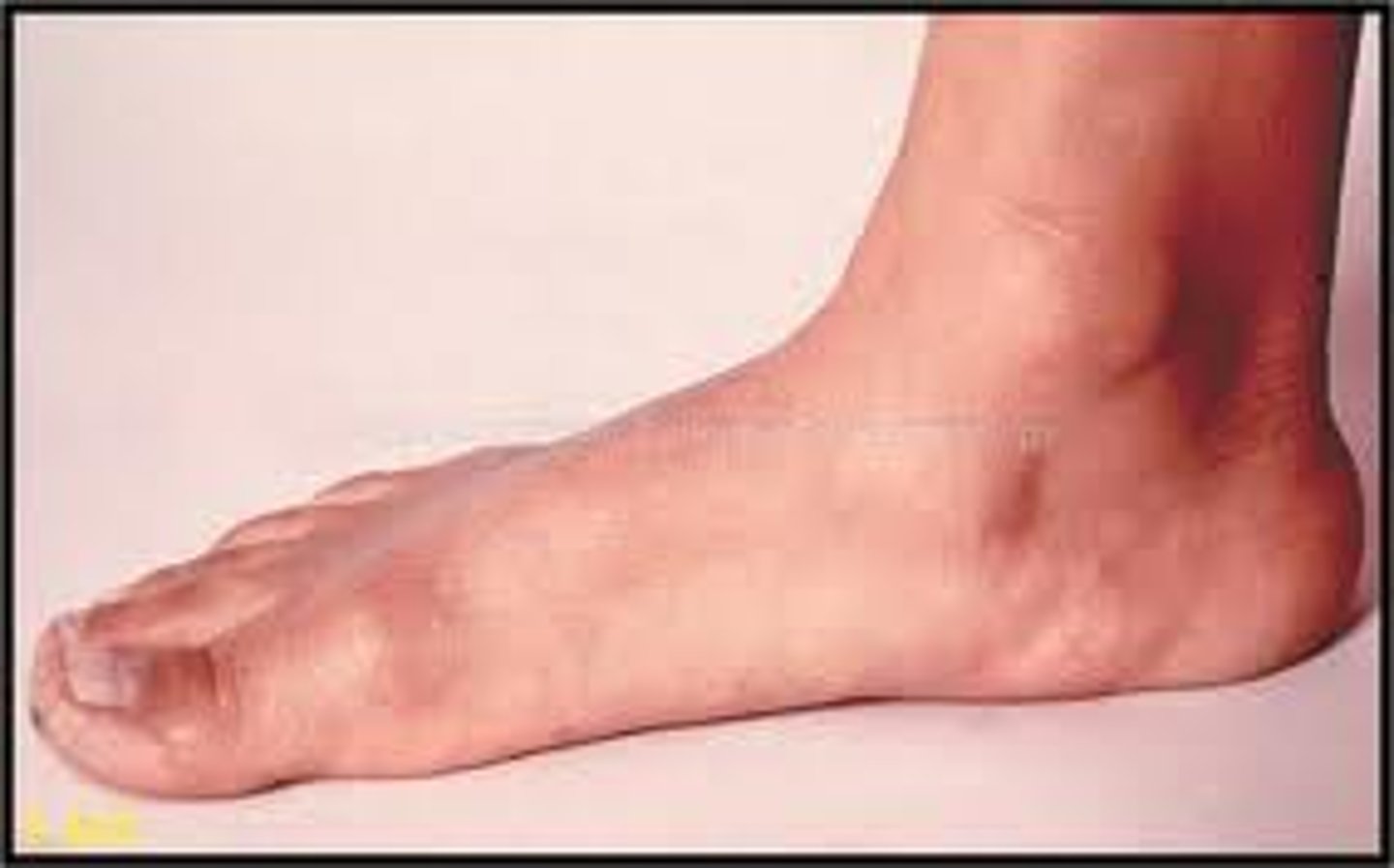 <p>has no arch and may cause pain and swelling of the foot surface</p>