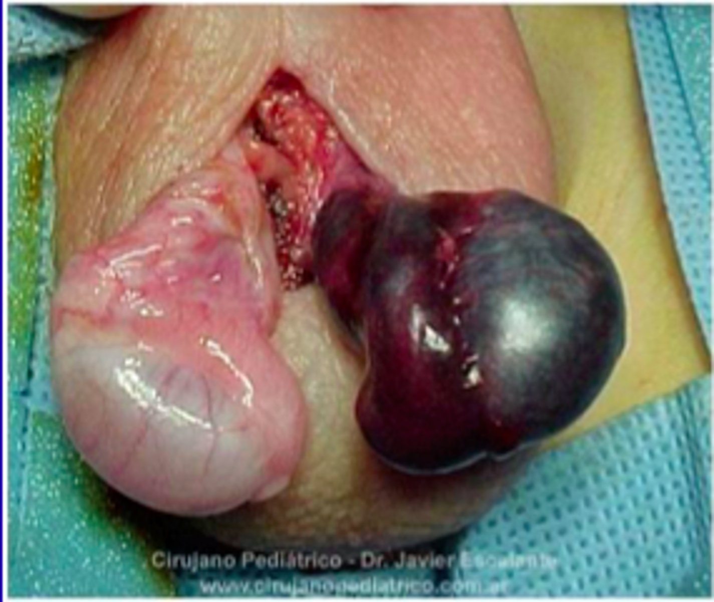 <p>Diagnosis: US</p><p>Treatment: manual detorsion &amp; surgery (orchiopexy - prevents recurrence)</p>