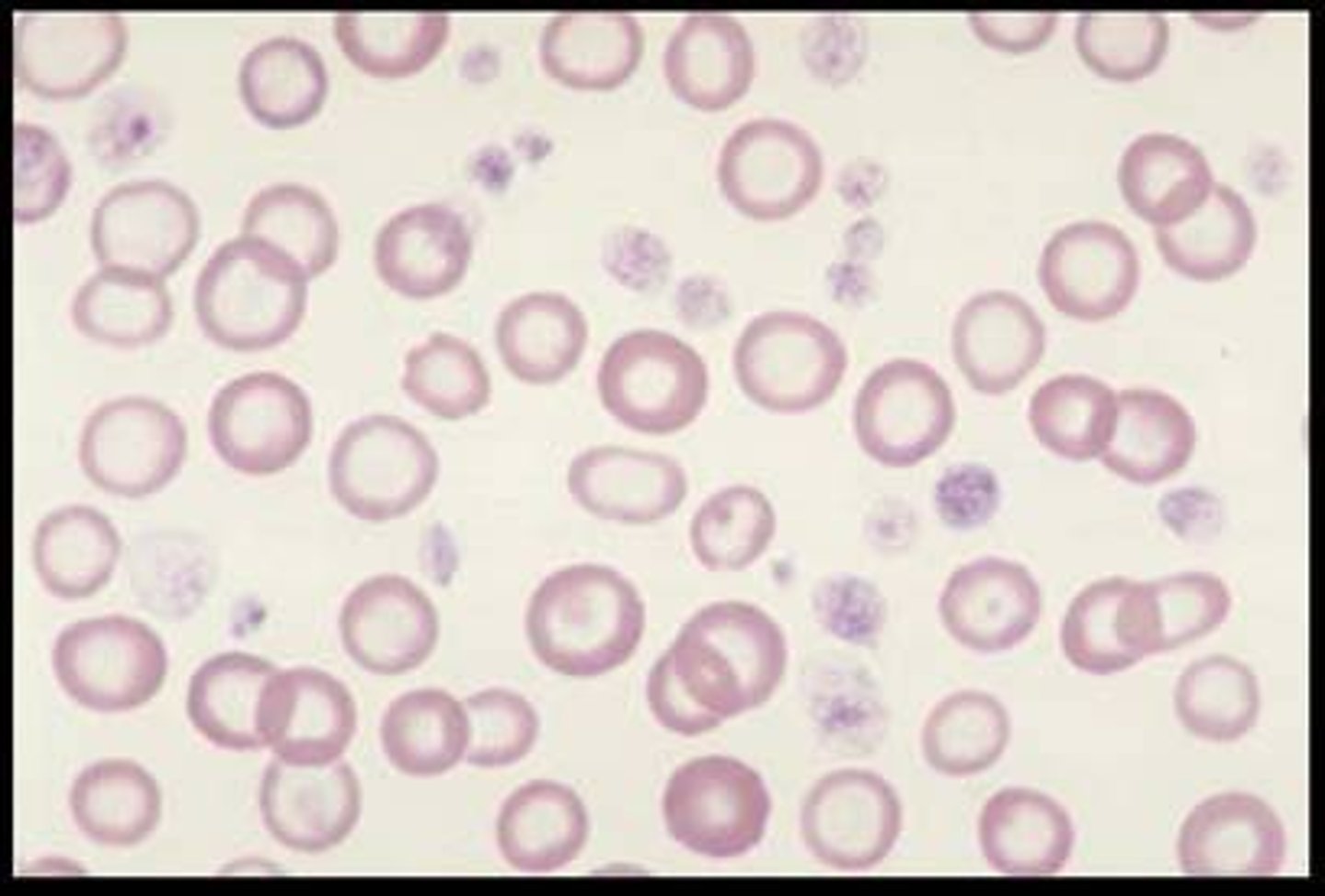 <p>pale RBC (more white than pink)</p><p>The central pallor is the white part greater than one-third of the cell diameter.</p>