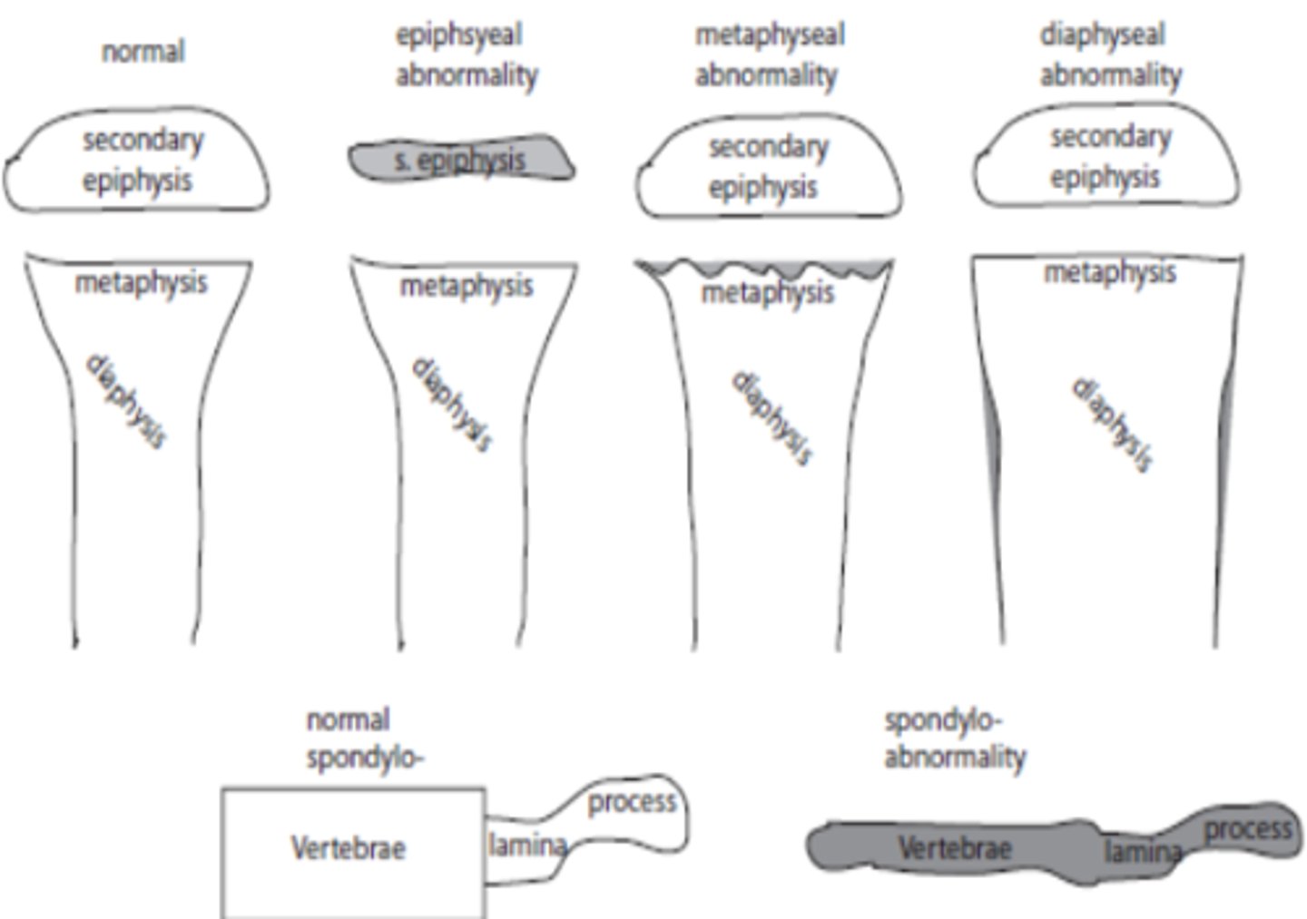 <p>Spondylo</p><p>Epiphyseal</p><p>Metaphyseal</p><p>Diaphyseal</p>