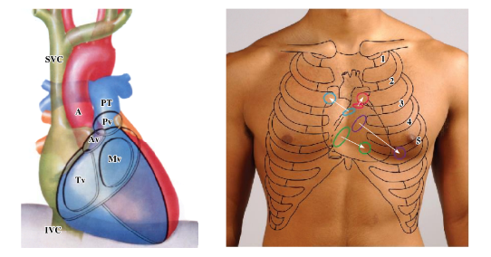 <p>-valves of heart NOT best heard where they are located</p><p>-best heard with minimal interference:</p><p>-aortic valve: second intercostal space to the right of the sternum</p><p>-pulmonary valve: second intercostal space to the left of the sternum</p><p>-mitral valve: fifth intercostal space in midclavicular line</p><p>-tricuspid valve: fifth intercostal space to the left of the sternum</p>