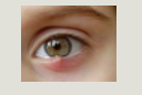<p>stye (hordeolum)</p>