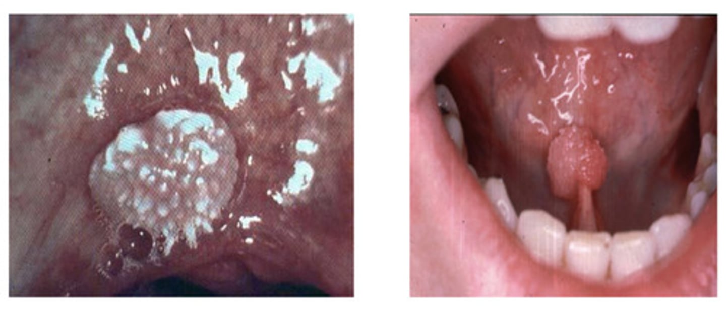 <p>Squamous cell papilloma has the identical appearance to what ?</p>